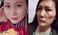 整形失敗，女子被說老，整形前后差異大揭秘(整形失敗過程)