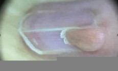 女子頻繁美甲引發(fā)甲周纖維瘤的原因及預防方法 - 副本