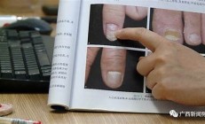 女子美甲過度引發(fā)甲周纖維瘤 專家解讀(做美甲會長倒刺嗎)